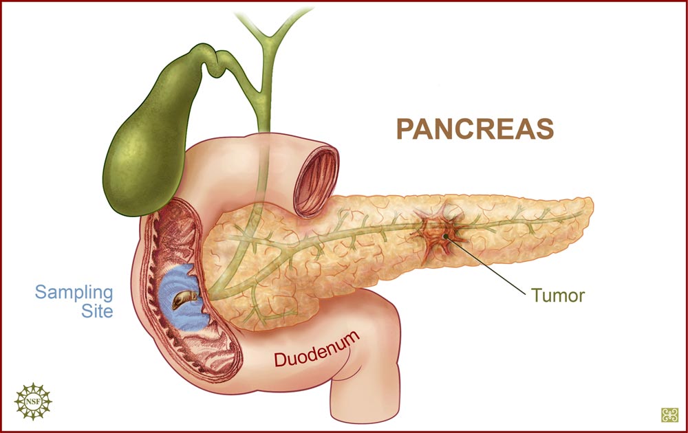 floating-stool-a-sign-of-pancreatic-cancer