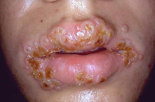 herpes pictures. tested for herpes earlier