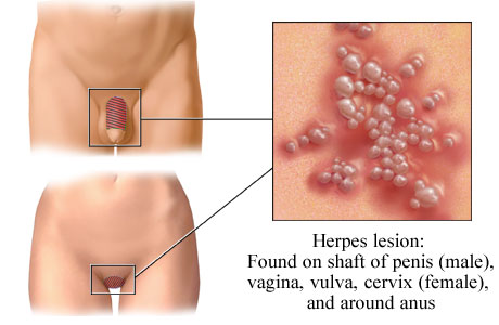 herpes symptoms pictures. Do herpes symptoms come and go