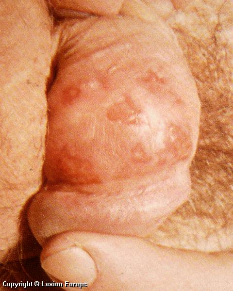 herpes genital symptoms. related to genital herpes,