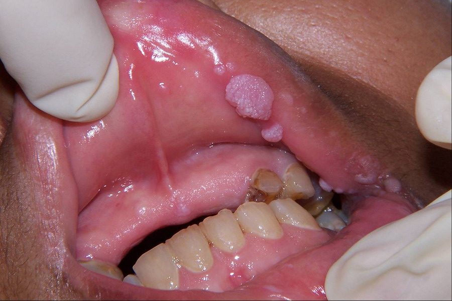 Bad Taste In Throat When Swallowing 95